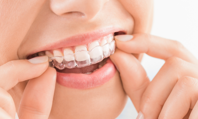 The Benefits Of Invisalign: Why It’s More than Just A Clear Alternative To Braces?