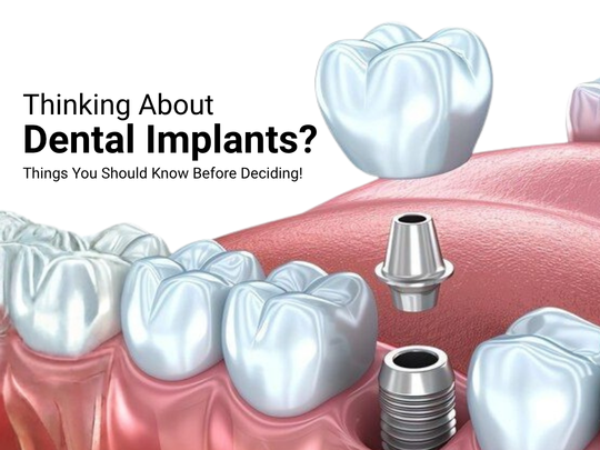 Thinking About Dental Implants